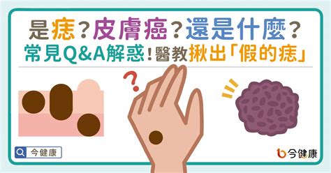 脖子痣長毛|是痣？還是皮膚癌？皮膚科醫師教你揪出「假的痣」，。